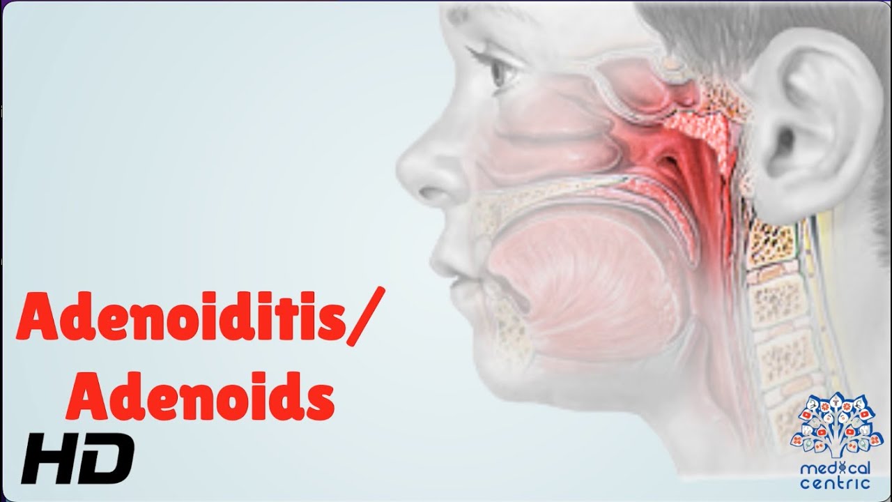 Adenoiditis/Adenoids: Everything You Need To Know