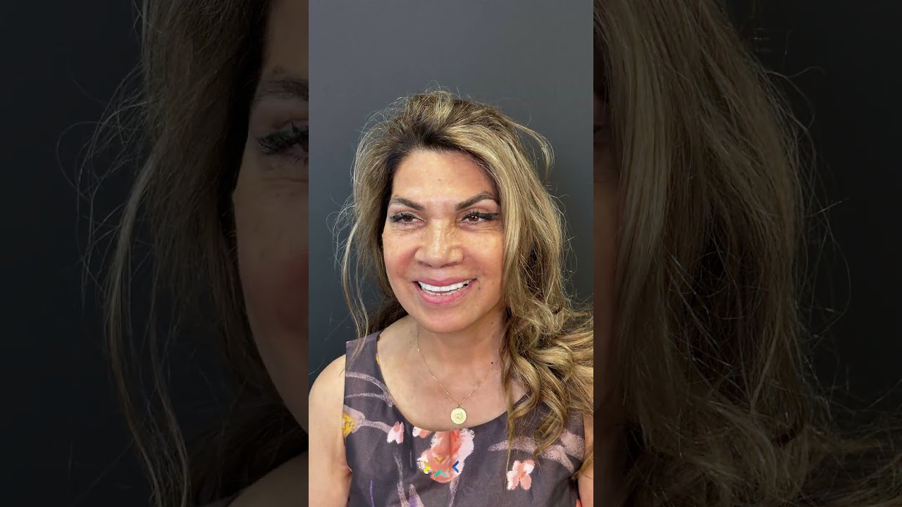 Hollywood Smile - Before & After