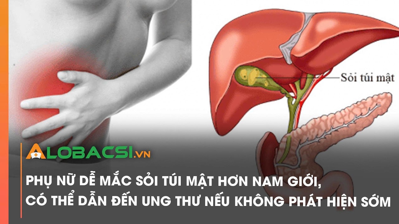 Phụ nữ dễ mắc sỏi túi mật hơn nam giới, có thể dẫn đến ung thư nếu không phát hiện sớm