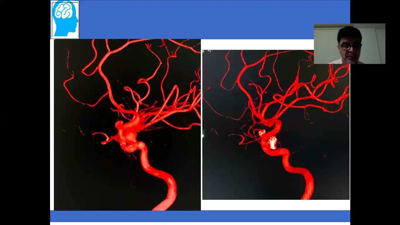 3  tratamiento Endovascular de Aneurismas  Consideraciones Prácticas