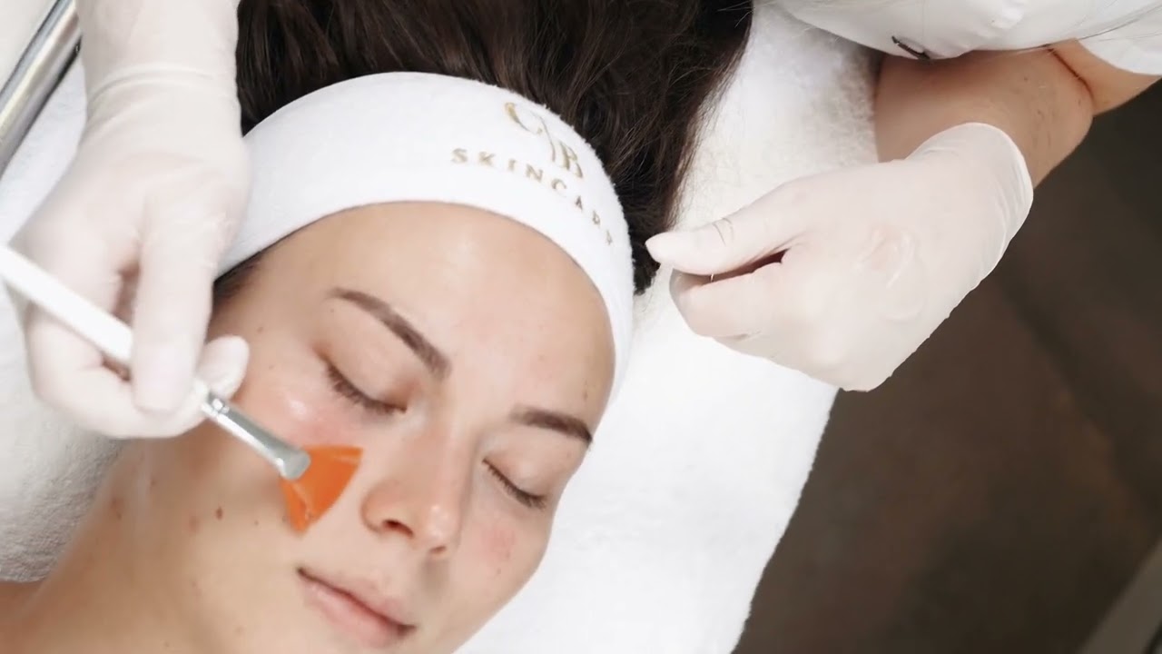 Microneedling acne littekens