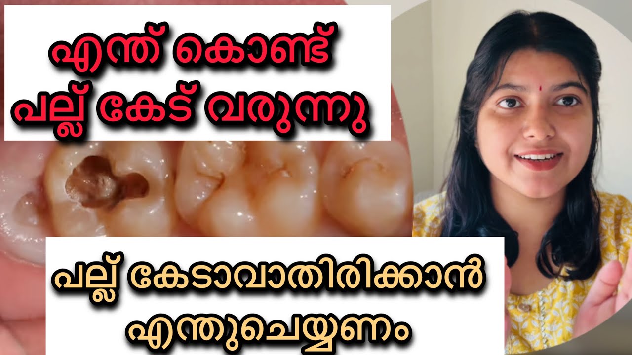 പല്ല്കേടാവുന്നത് എന്ത്കൊണ്ട്? എങ്ങനെ തടയാം?Dentalcaries#teethdecay #cavity  @Devinevibez-q6n 