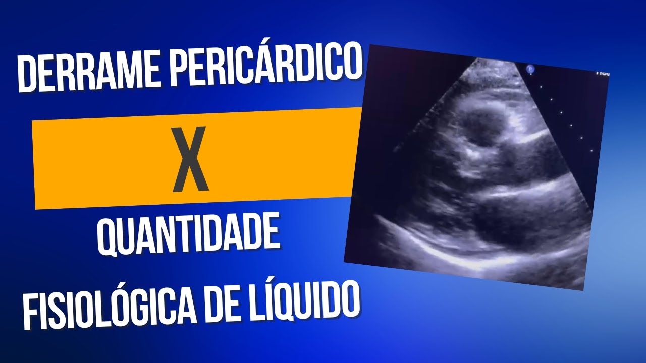 Derrame pericárdico discreto ou Quantidade fisiológica de líquido pericárdico? #pocus #ecocardio