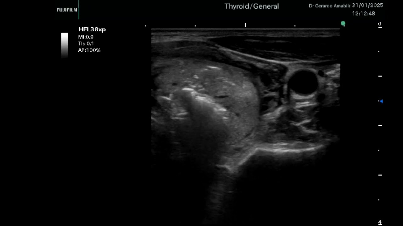 ECO MICROWAVE - THYROID NODULE ABLATION