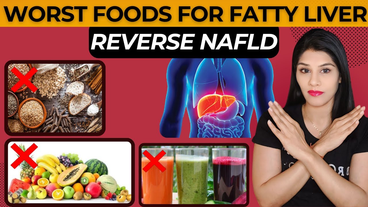 Avoid 5 Worst Foods to Reverse & Treat Non-Alcoholic Fatty Liver (NAFLD) #fattyliver #nafld #detox