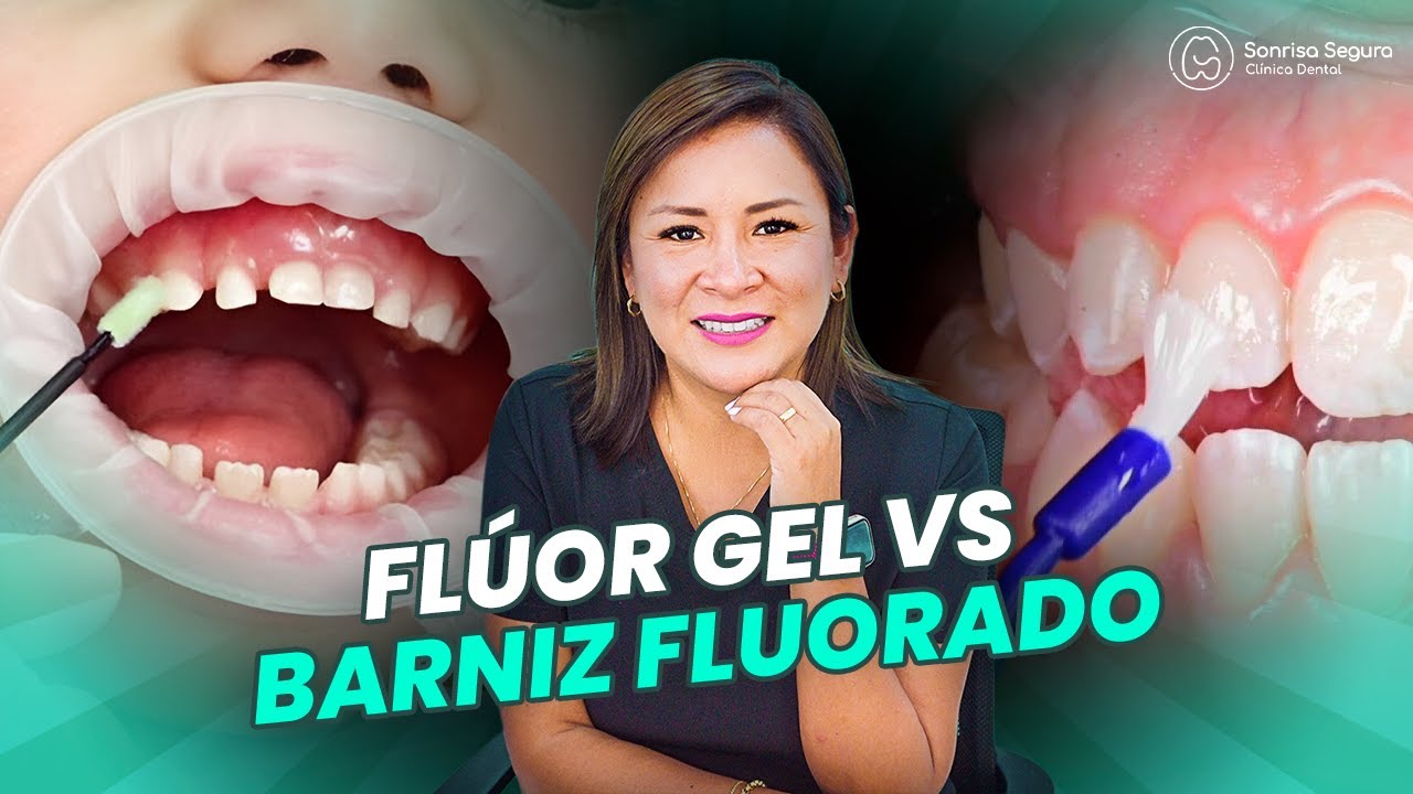 Flúor Gel VS Flúor Barniz: Beneficios y características esenciales