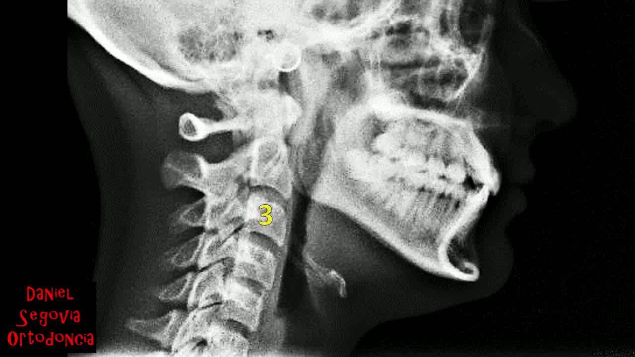 Evaluación cefalométrica rápida del hioides en ortodoncia