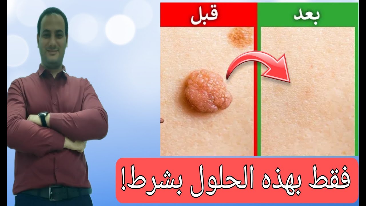 سبب فادح يقع به الملايين لظهور الثآليل | كيفية التخلص من الزوائد الجلدية والثآليل خلال يوم واحد!