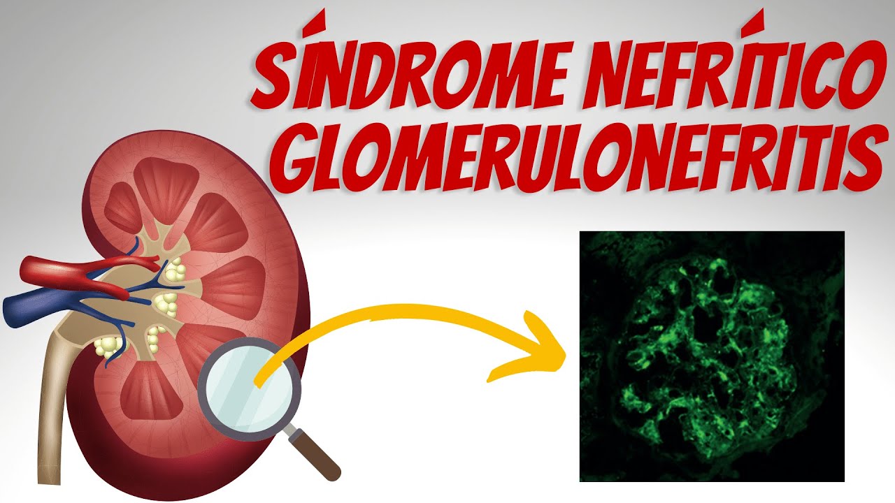 Síndrome Nefrítico - Glomerulonefritis Explicados Claramente