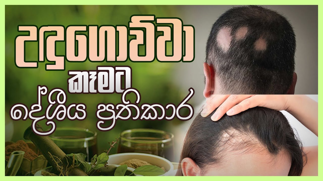 උඳුගොව්ව කෑමට දේශීය ප්&zwj;රතිකාර | Wedahamine