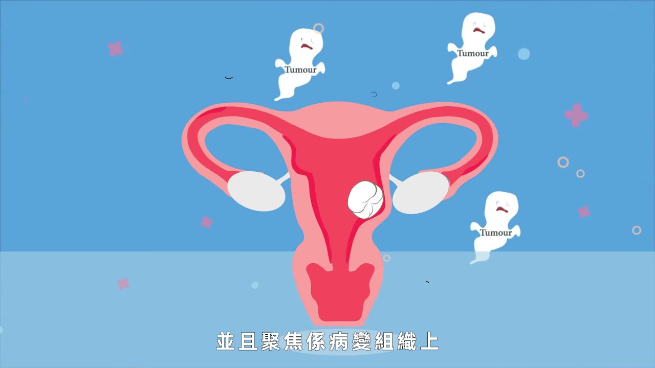 海扶刀&reg;Usg-HIFUa無創手術過程