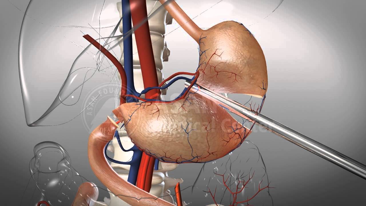 Subtotal Gastrectomy(60%)