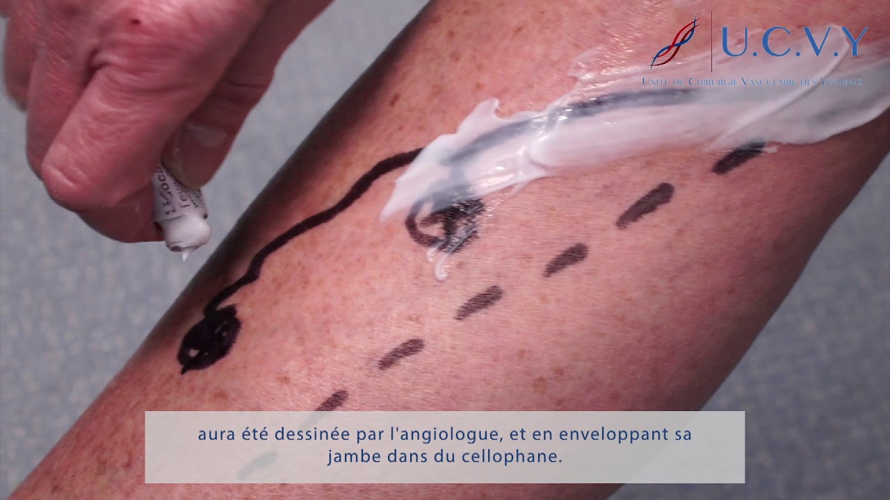 prise en charge des varices au CHP Europe