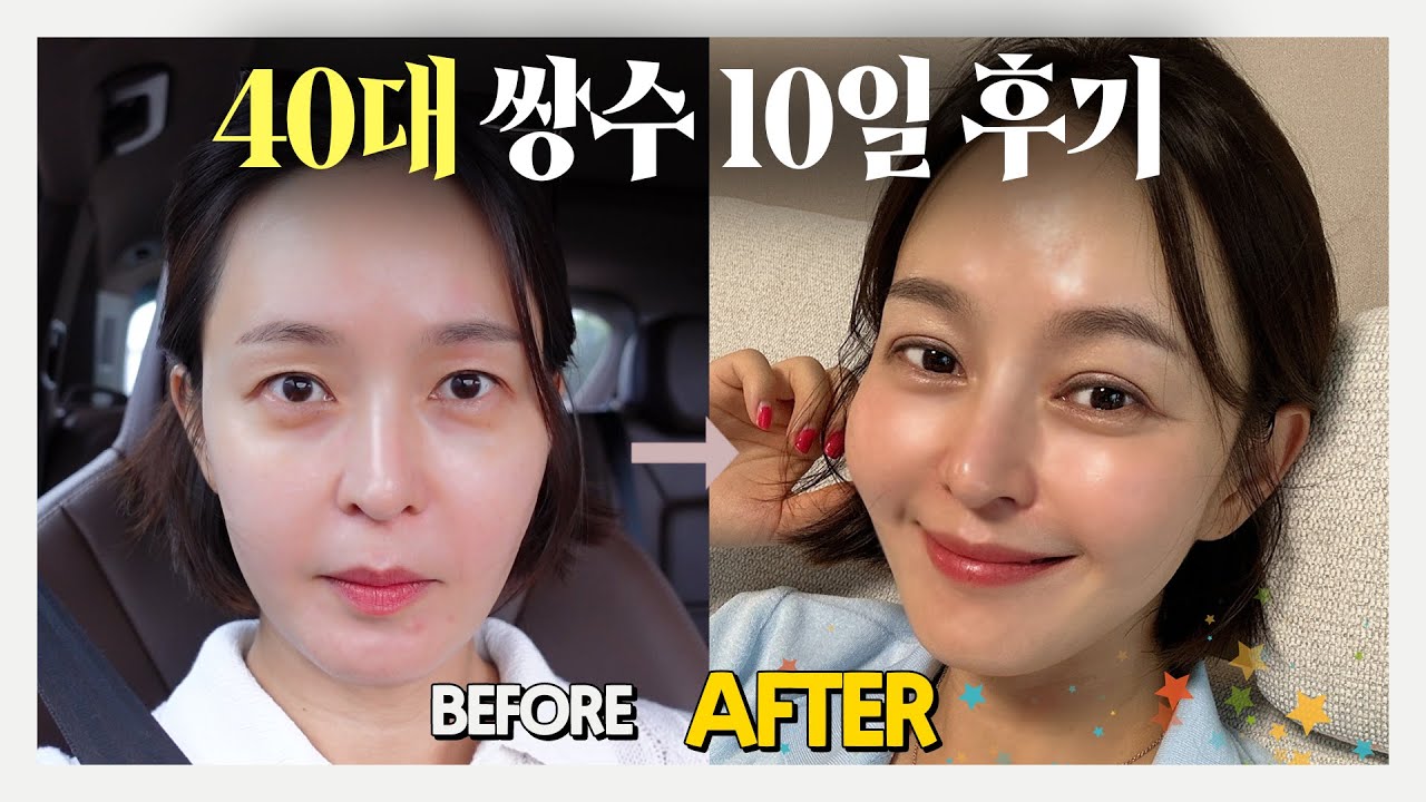 [Vlog] 40대 쌍꺼풀 재수술 10일 동안 𝑹𝑬𝑨𝑳하게 담았어요!│처진 눈│눈매 교정│아웃라인 만들기│쌍꺼풀 붓기