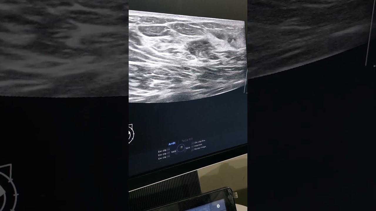pose d'un clip mammaire sous echographie
