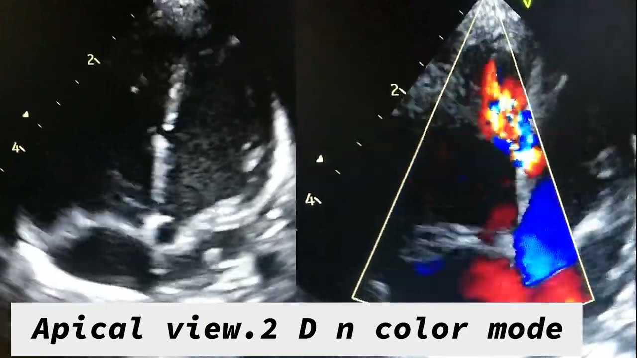 Mid muscular VSD