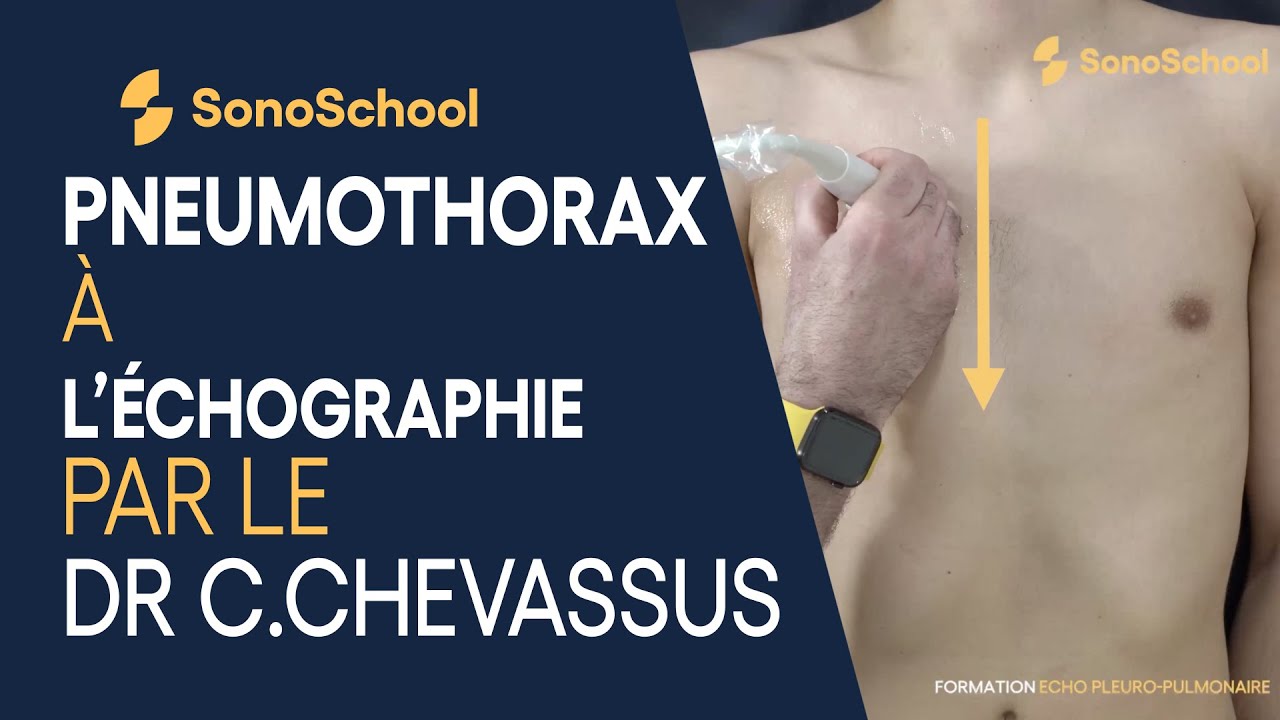 Comment détecter un pneumothorax : Échographie pleuro-pulmonaire – iSonic | SonoSchool