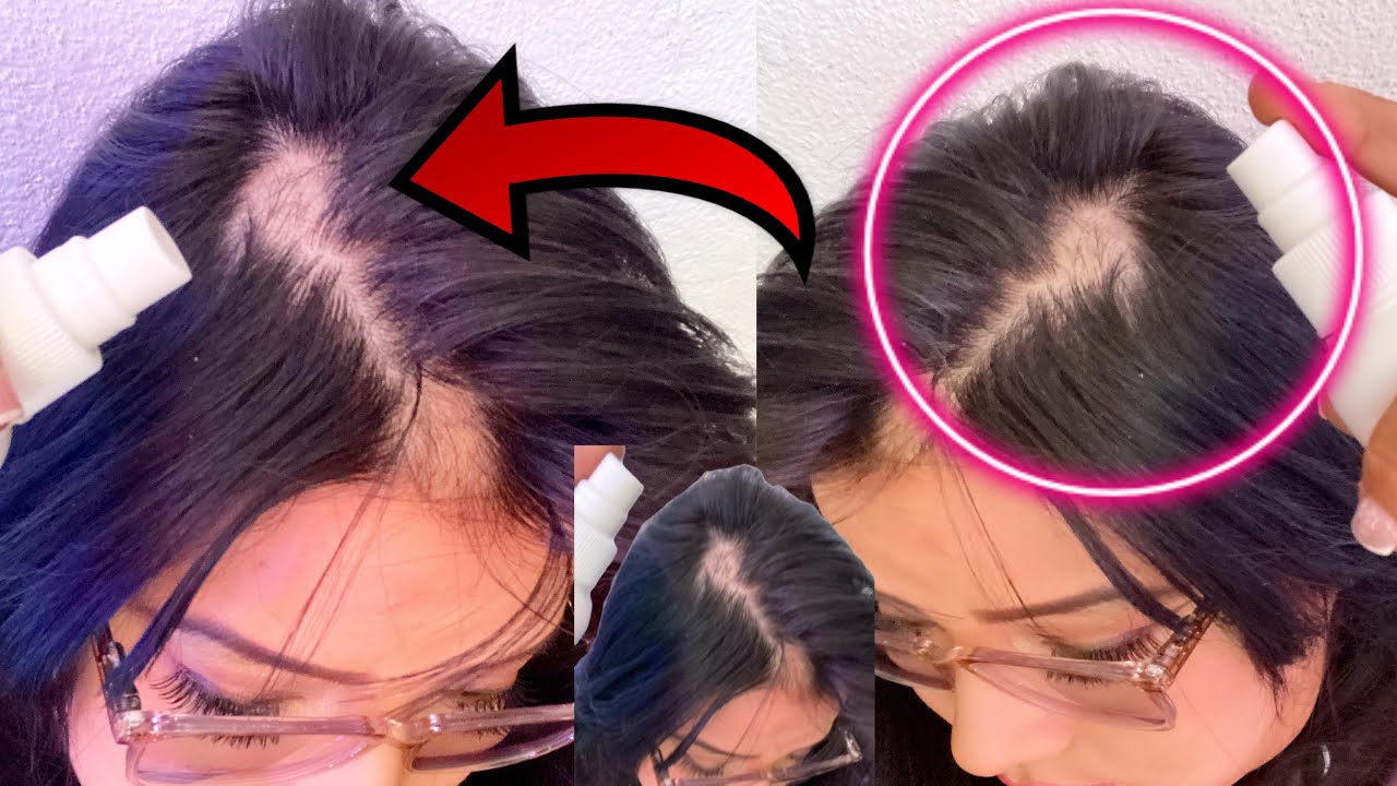 C&oacute;mo curar la alopecia areata? C&oacute;mo uso mi tratamiento anticaida