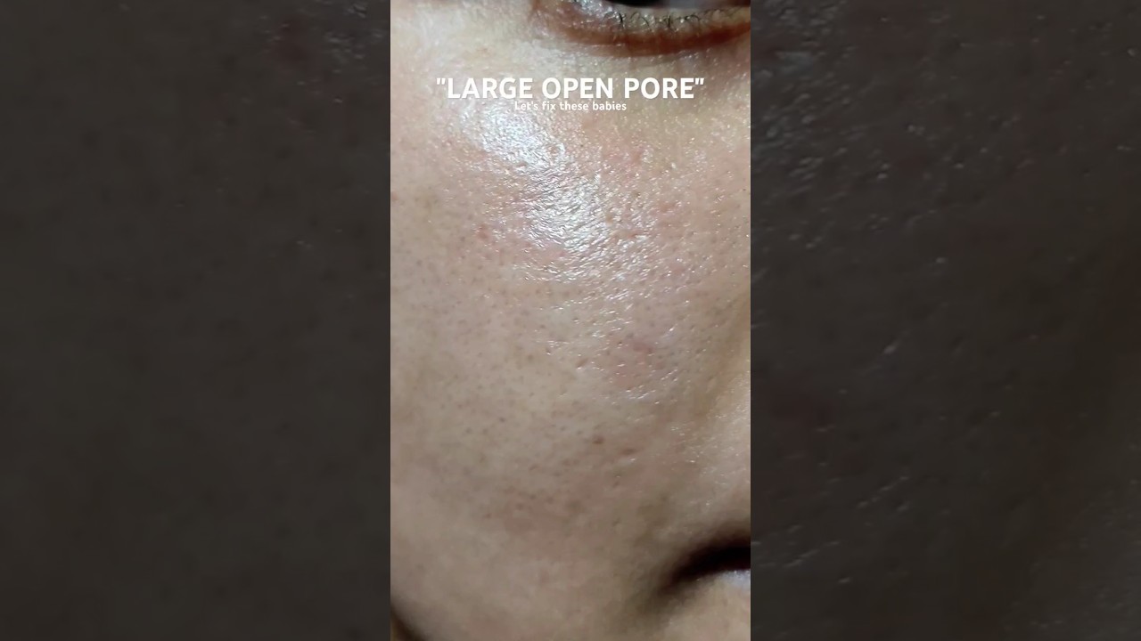get rid of large open pores and acne scars - day 1 update #tretinoin #largeopenpores #acnescars#acne