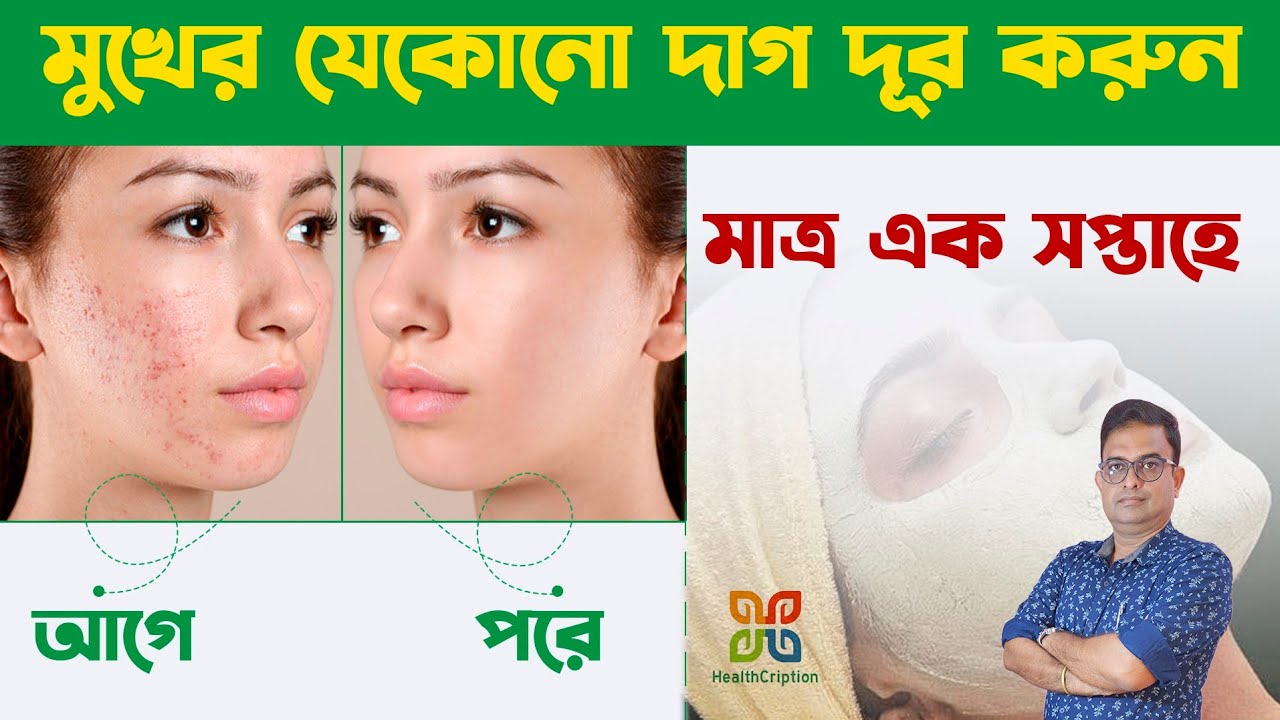 Any spots On Face & its best Natural Home remedies. মুখের যেকোনো দাগ কমার একমাত্র ঘরোয়া চিকিৎসা।
