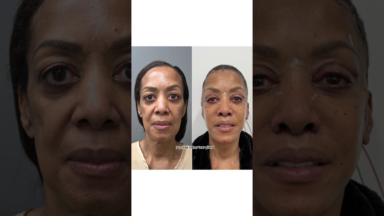 Less Than 24 Hours After A Full Face Rejuvenation 😱 She Already Looks 20 Years Younger!