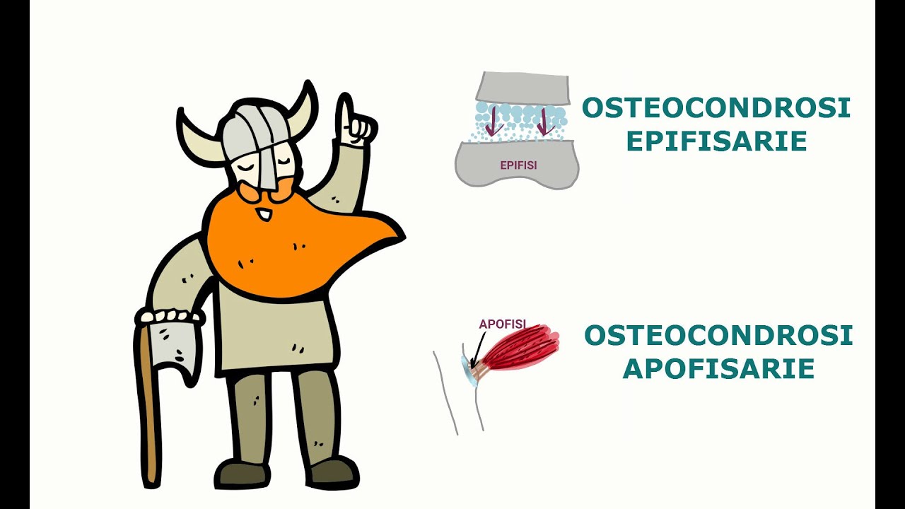 Morbo della crescita, malattia di Perthes e altre osteocondrosi