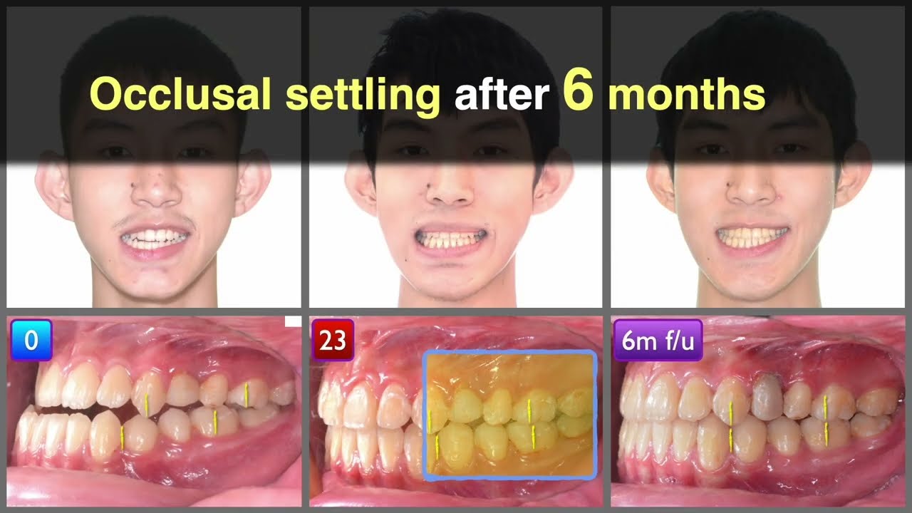 Class III Openbite & Facial Asymmetry Treated by Damon Ultima｜【Chris Chang Ortho】CC868