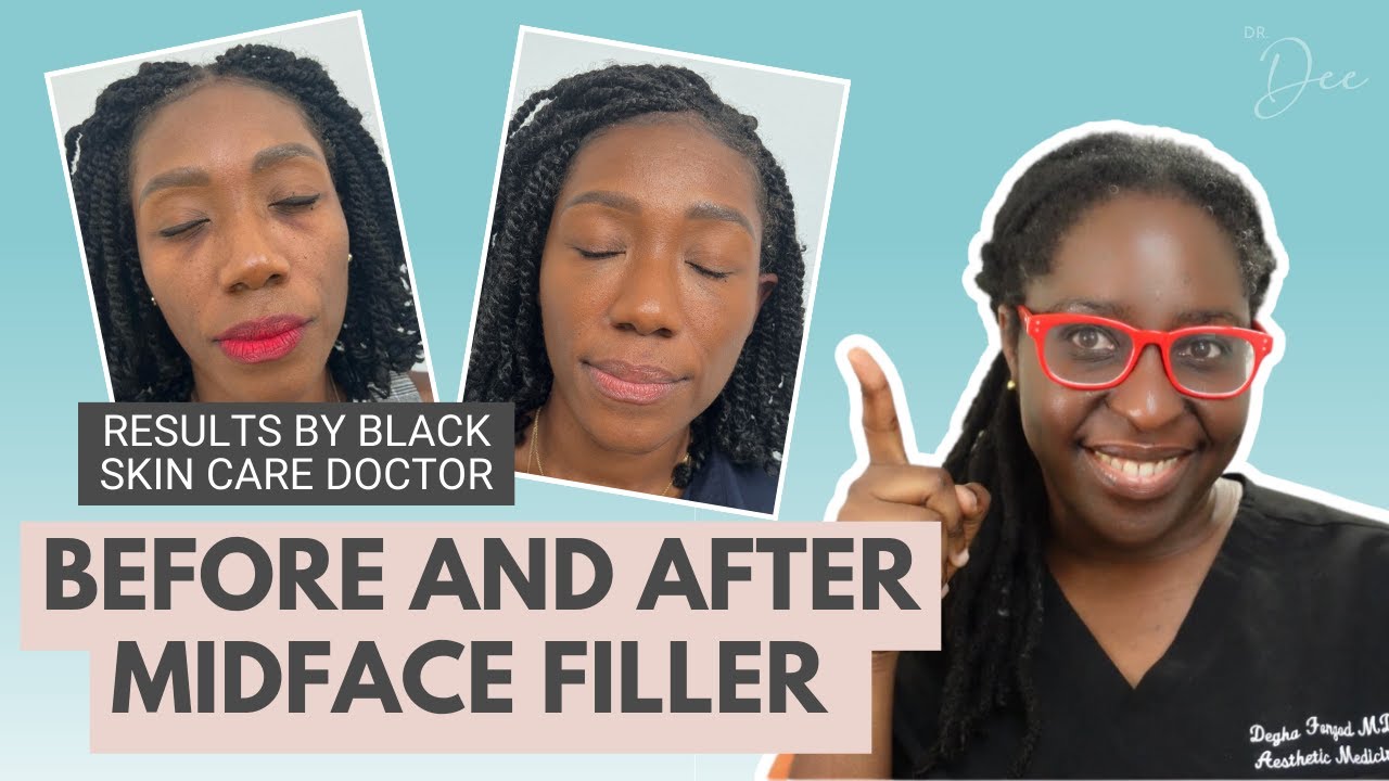 MID FACE FILLER BEFORE AND AFTER | BLACK SKIN CARE DOCTOR