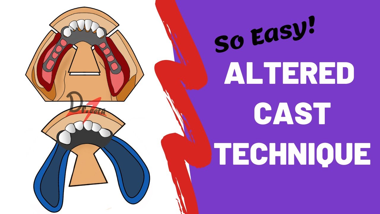 Altered Cast Technique in Prosthodontics