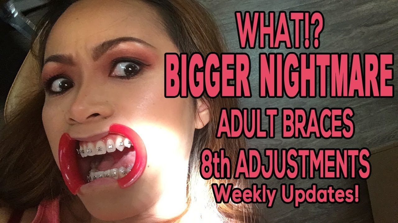 LIFE VLOG: ADULT BRACES WEEKLY UPDATES 8TH ADJUSTMENTS BIGGER NIGHTMARE! | ARREM