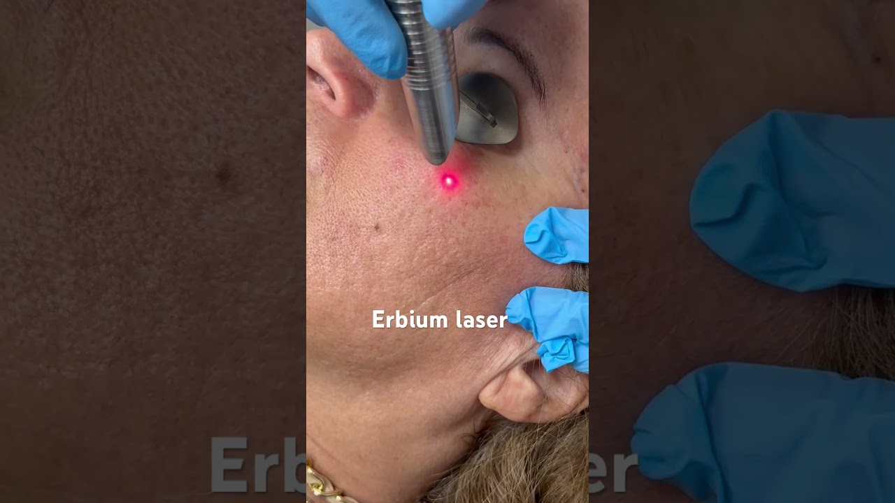 Erbium laser at Newman Dermatology for skin resurfacing and sun spot removal