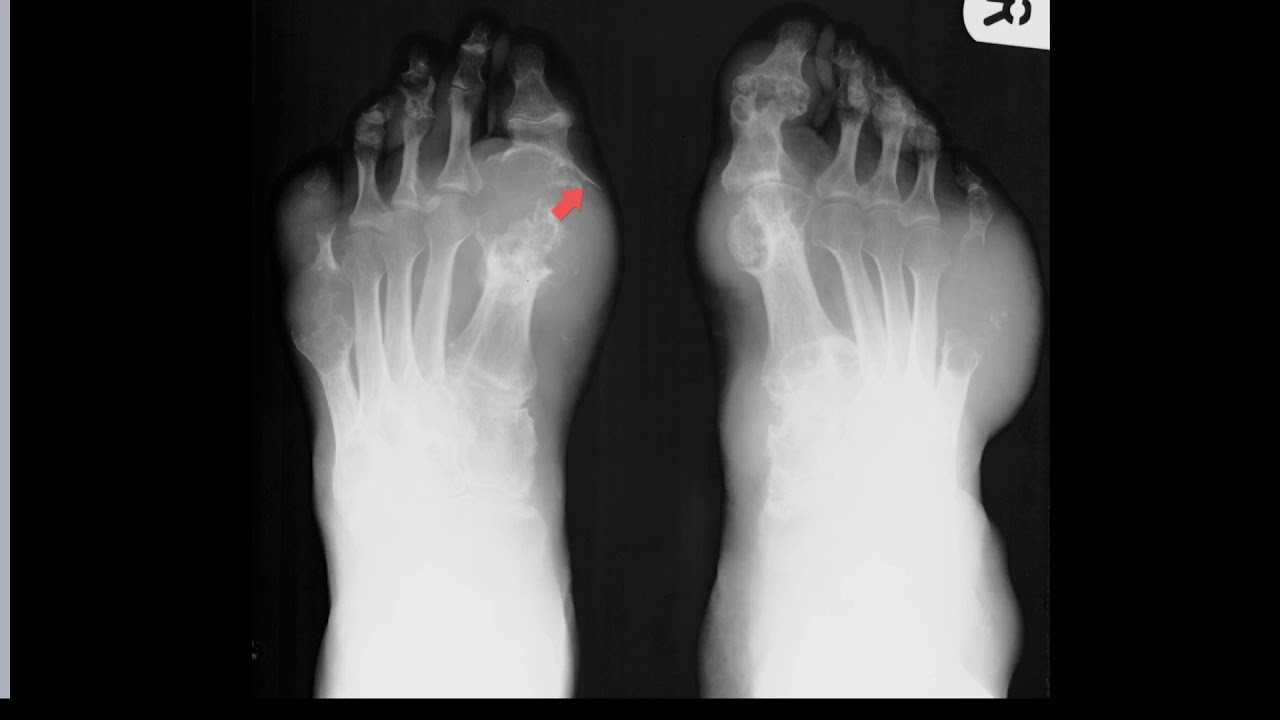 Gout - so how does it look on medical imaging?