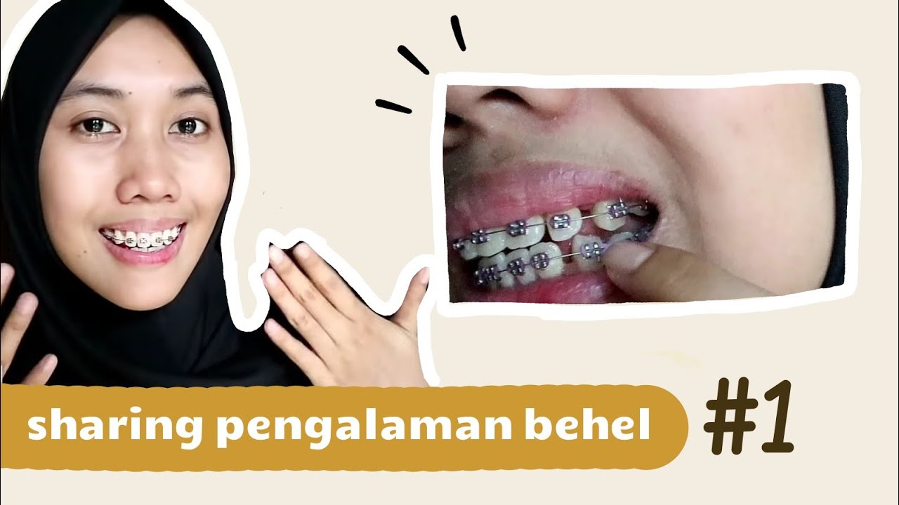 Pengalaman Pasang Behel #1 - Jadi Ompong
