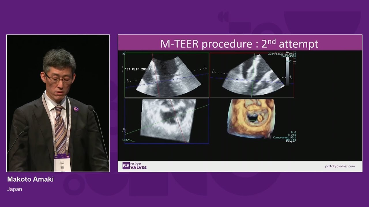 More possibilities in TEER - Treatment of degenerative mitral regurgitation - PCR Tokyo Valves 2025