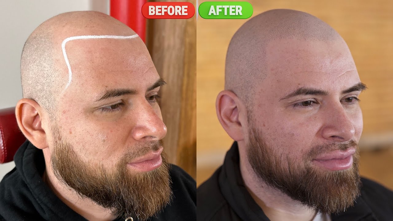 Scalp Micropigmentation Fixes Edgar's Hair Loss
