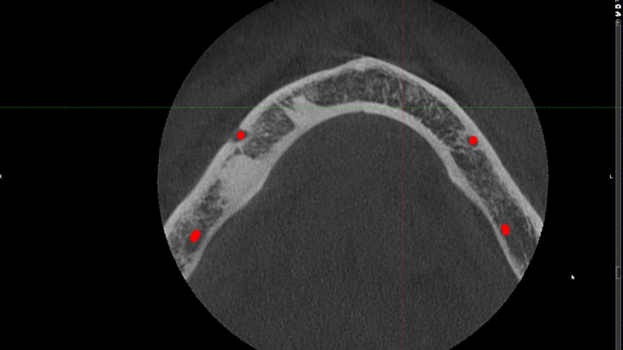Two unknown radiopacities in the mandible shown in PA, Pano, CBCT
