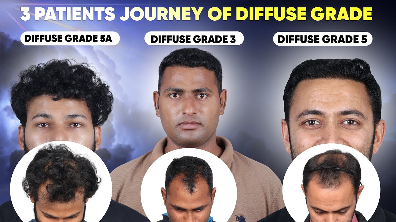 Hair Transplant in Mangaluru (HX-TYUP) | Best Results & Cost of Hair Transplant in Mangaluru