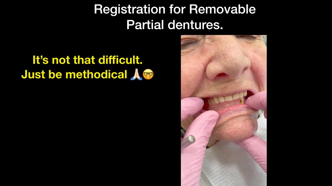 Registration sequence for a removable partial denture