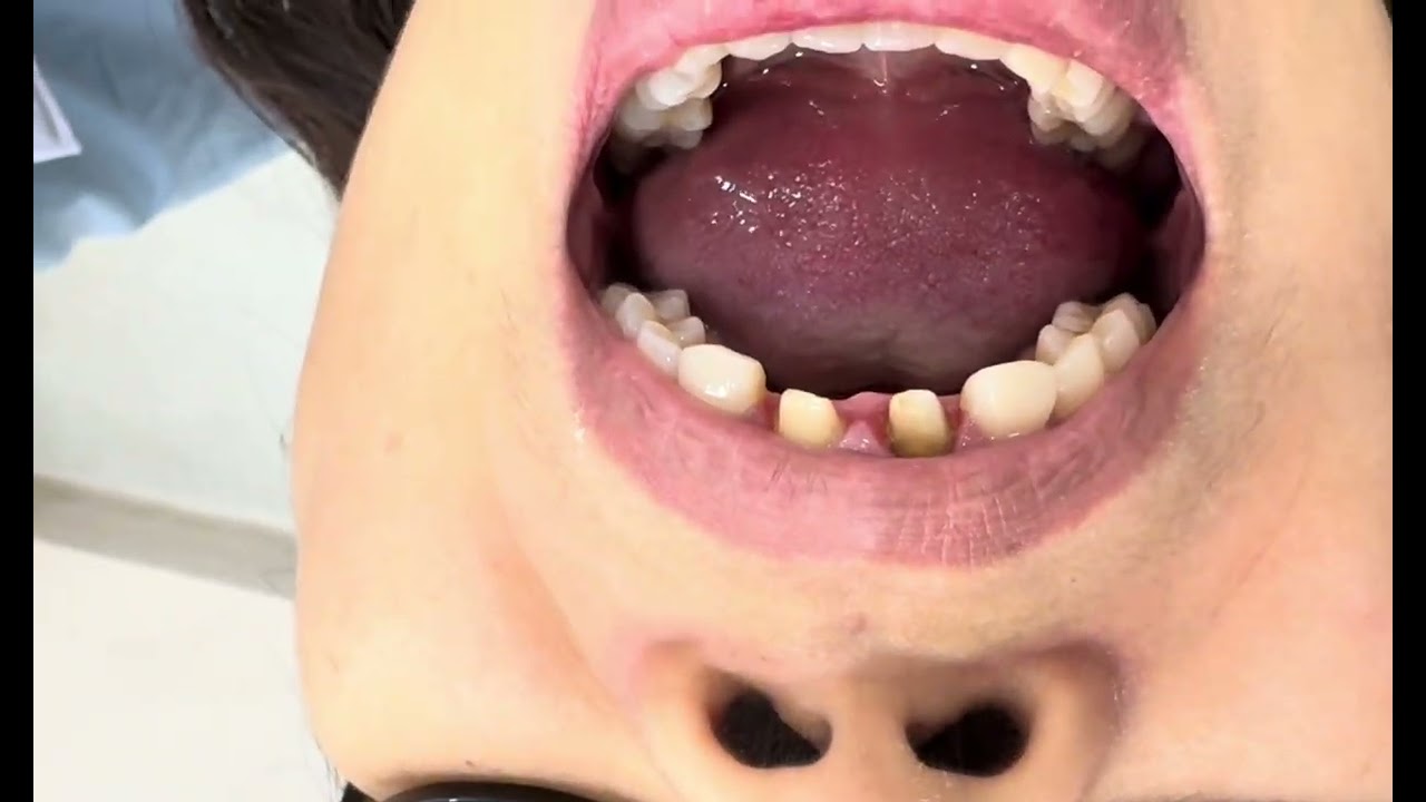 Dental Magic ✨ See How Zirconia Crowns Transform Teeth