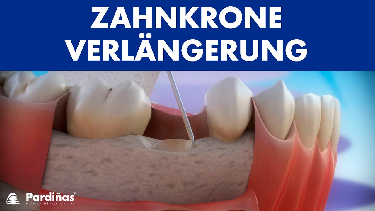 Zahnkrone Verl&auml;ngerung &copy;