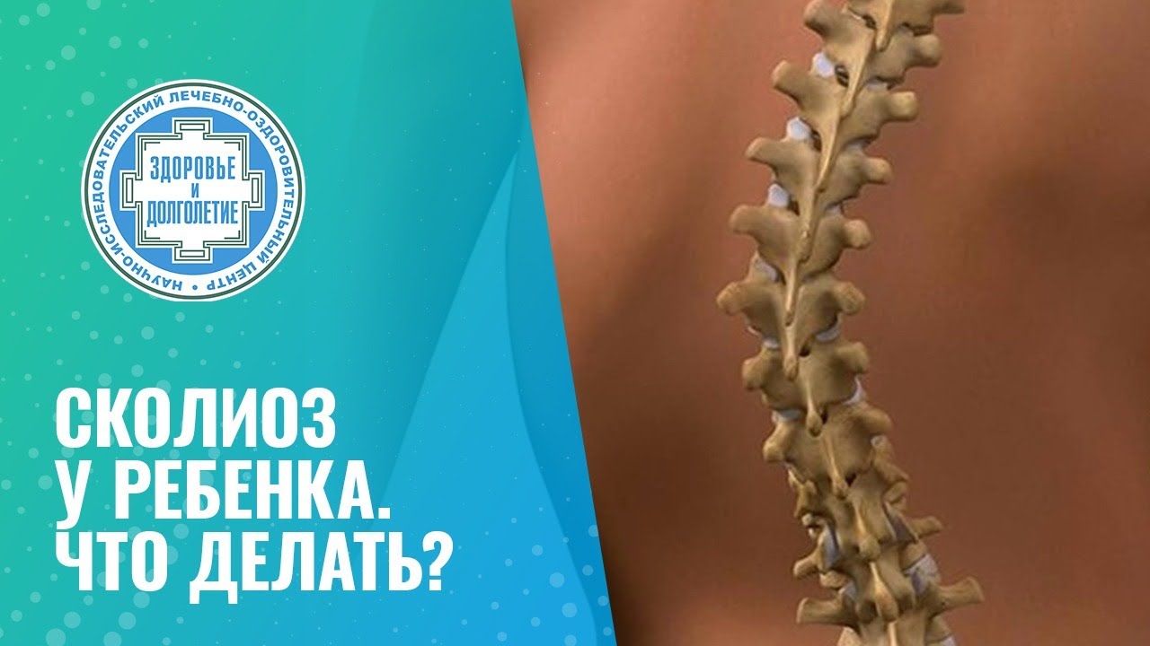 🧒 Сколиоз у ребенка. Что делать?