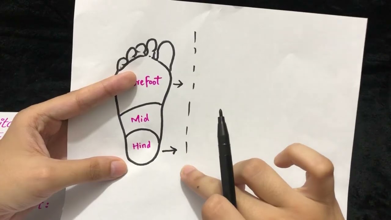 Club Foot (CTEV) | Pediatric Physical Therapy Lecture & Management