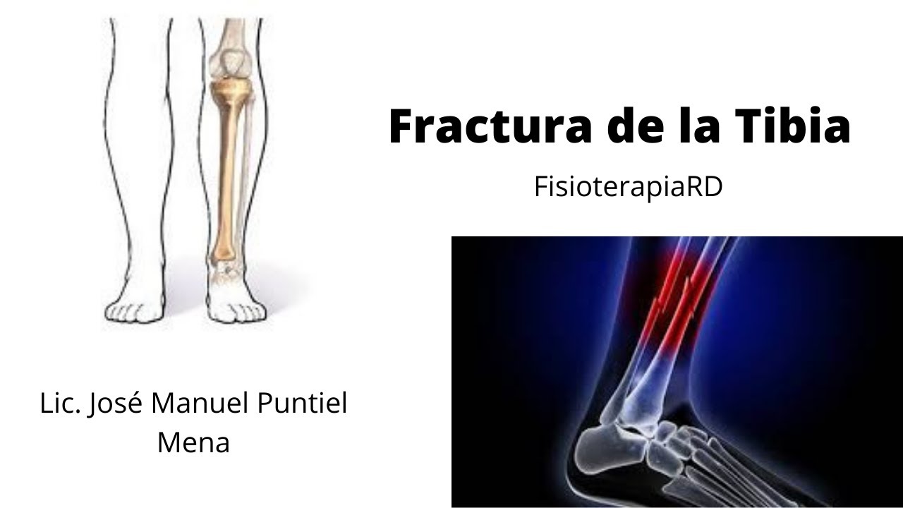 Rehabilitación luego de fractura de la tibia - Fisioterapia RD.