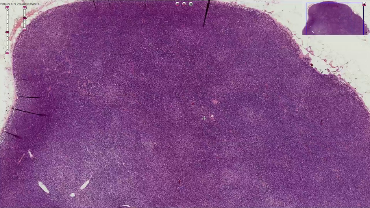 Histopathology - CLL/SLL - Chronic Lymphocytic Leukemia/Small Lymphocytic Lymphoma