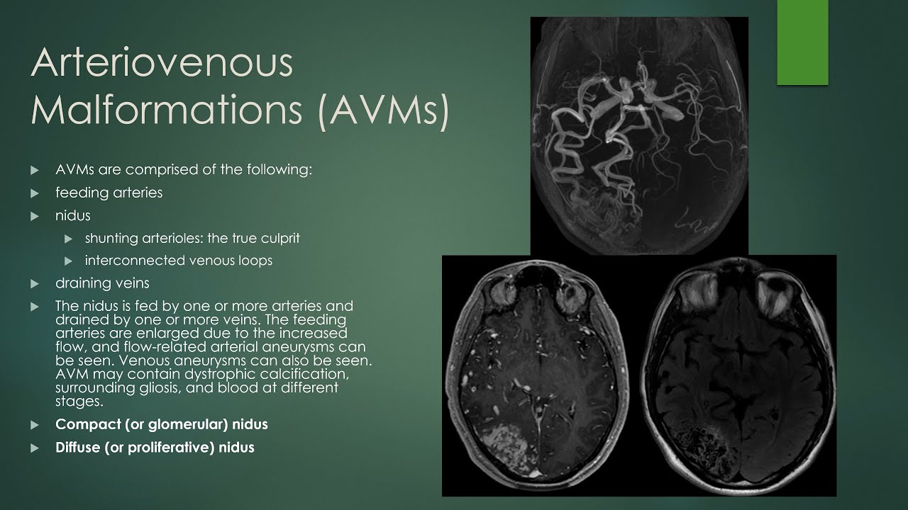 Brain vascular malformations