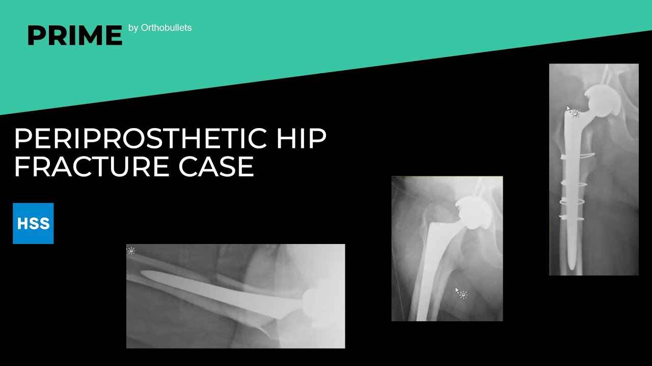 Periprosthetic Hip Fracture Case - Steven J. MacDonald, MD, FRCSC