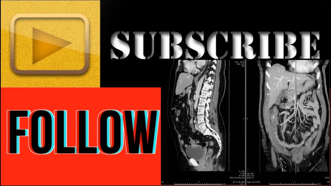 CT SCAN Hitachi Scenaria 128 Slice: Actual Procedure Of Whole Abdomen With Contrast
