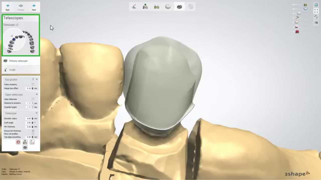 (German) 3Shape Dental System - Primary telescopes design