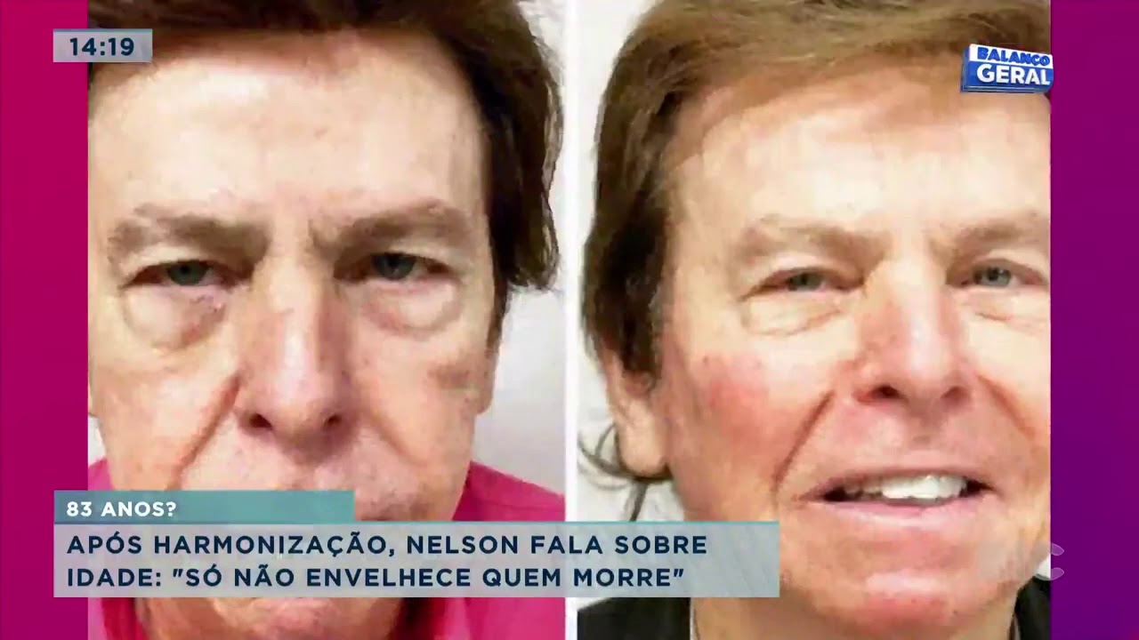 Ap&oacute;s harmoniza&ccedil;&atilde;o Nelson Rubens fala sobre idade: 