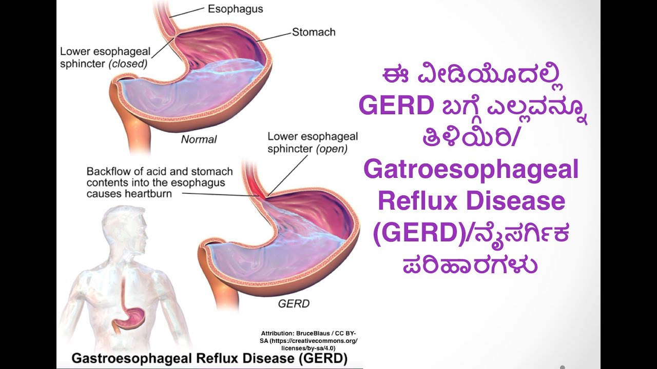 ಈ ವೀಡಿಯೊದಲ್ಲಿ GERD ಬಗ್ಗೆ ಎಲ್ಲವನ್ನೂ ತಿಳಿಯಿರಿ/Gatroesophageal Reflux Disease (GERD)/ನೈಸರ್ಗಿಕ ಪರಿಹಾರಗಳು